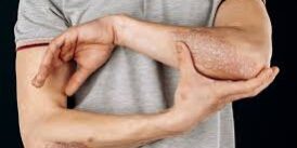 Managing Psoriasis and Overall Wellness