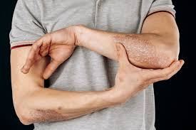 Managing Psoriasis and Overall Wellness