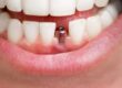 The Long-term Benefits of Dental Implants for Tooth Replacement
