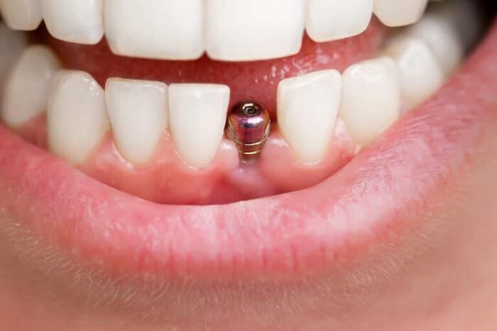 The Long-term Benefits of Dental Implants for Tooth Replacement The Long-term Benefits of Dental Implants for Tooth Replacement