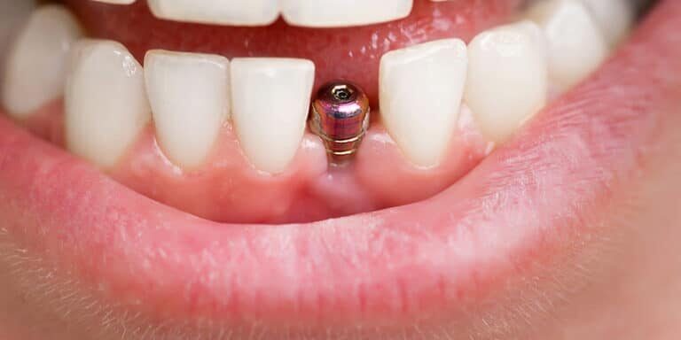 The Long-term Benefits of Dental Implants for Tooth Replacement The Long-term Benefits of Dental Implants for Tooth Replacement