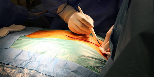 The Recovery Process After Hernia Surgery The Recovery Process After Hernia Surgery