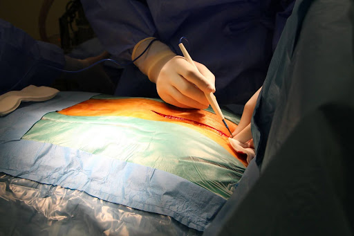 The Recovery Process After Hernia Surgery The Recovery Process After Hernia Surgery