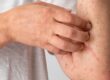 Understanding Allergy Testing Types and What To Expect
