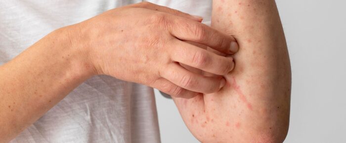 Understanding Allergy Testing Types and What To Expect Understanding Allergy Testing Types and What To Expect