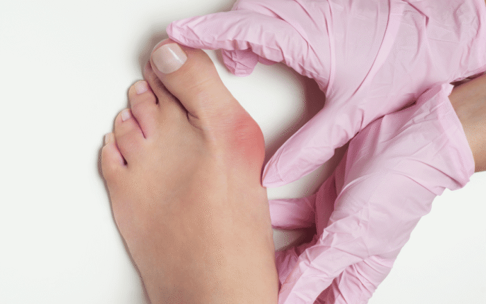 Understanding the Role of Genetics in Bunions Understanding the Role of Genetics in Bunions