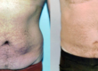 What You Need to Know About Liposuction Techniques