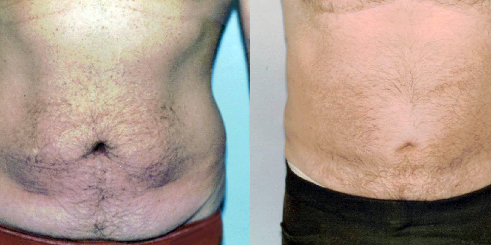 What You Need to Know About Liposuction Techniques What You Need to Know About Liposuction Techniques