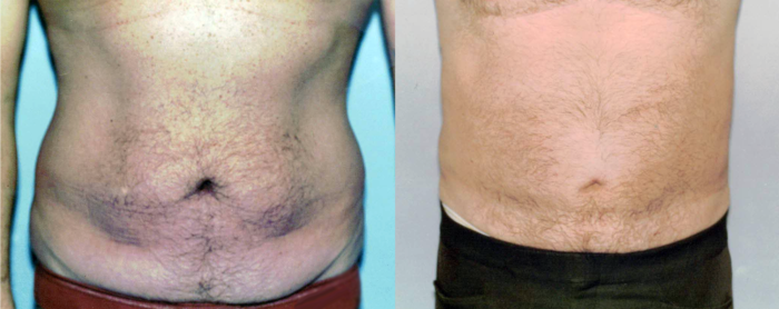 What You Need to Know About Liposuction Techniques