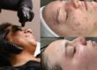 Causes of Acne and How To Treat It