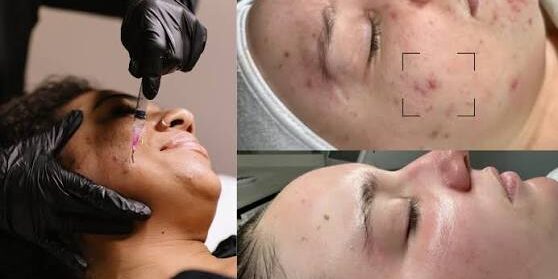 Causes of Acne and How To Treat It Causes of Acne and How To Treat It