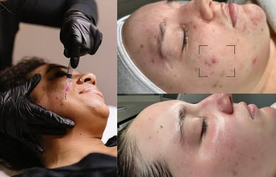 Causes of Acne and How To Treat It