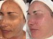 How Photo Facials Improve Skin Texture and Tone