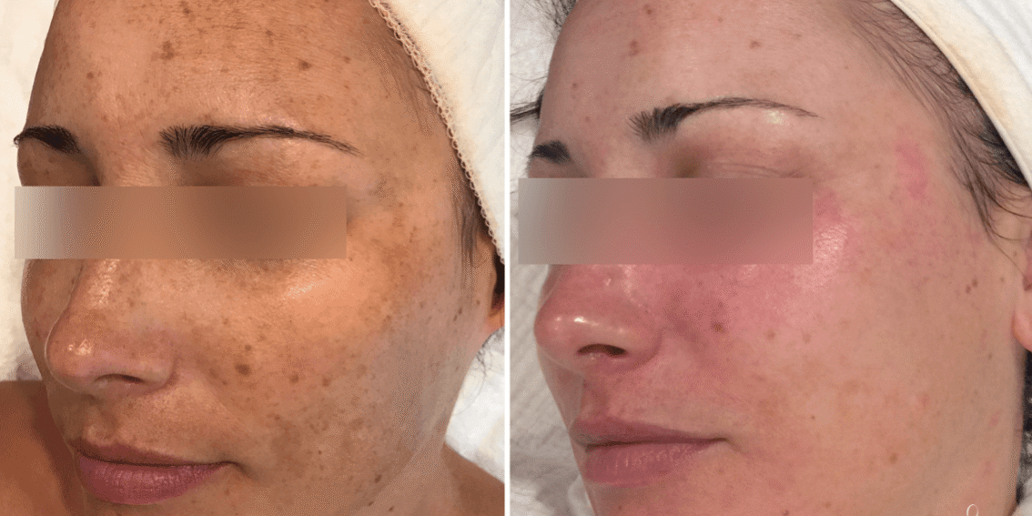 How Photo Facials Improve Skin Texture and Tone