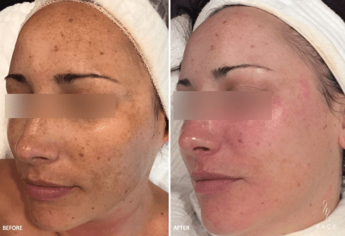 How Photo Facials Improve Skin Texture and Tone