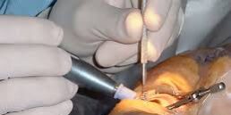 The Recovery Process After Cataract Surgery The Recovery Process After Cataract Surgery