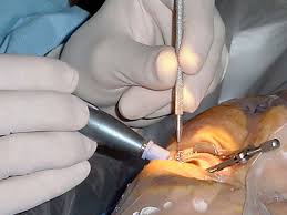 The Recovery Process After Cataract Surgery The Recovery Process After Cataract Surgery