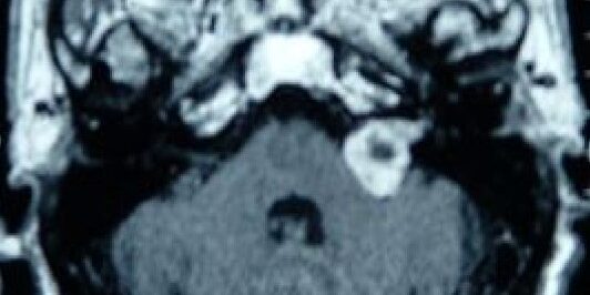 The Role of Acoustic Neuroma in Hearing Impairment The Role of Acoustic Neuroma in Hearing Impairment