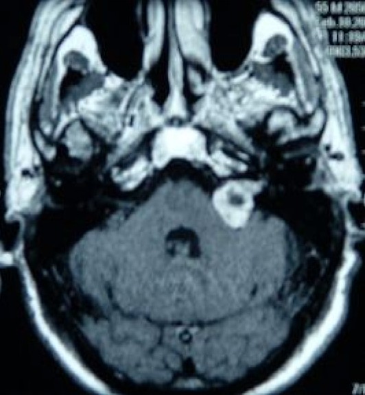 The Role of Acoustic Neuroma in Hearing Impairment