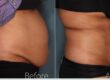 Understanding Liposuction and Its Benefits