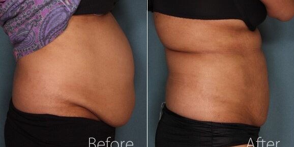 Understanding Liposuction and Its Benefits Understanding Liposuction and Its Benefits