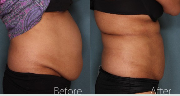 Understanding Liposuction and Its Benefits