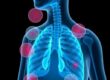 Understanding What Asthma Is